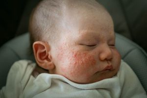 Read more about the article Baby Cystic Acne