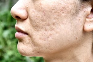 Read more about the article Cystic Acne – How to Clean Your Acne Skin