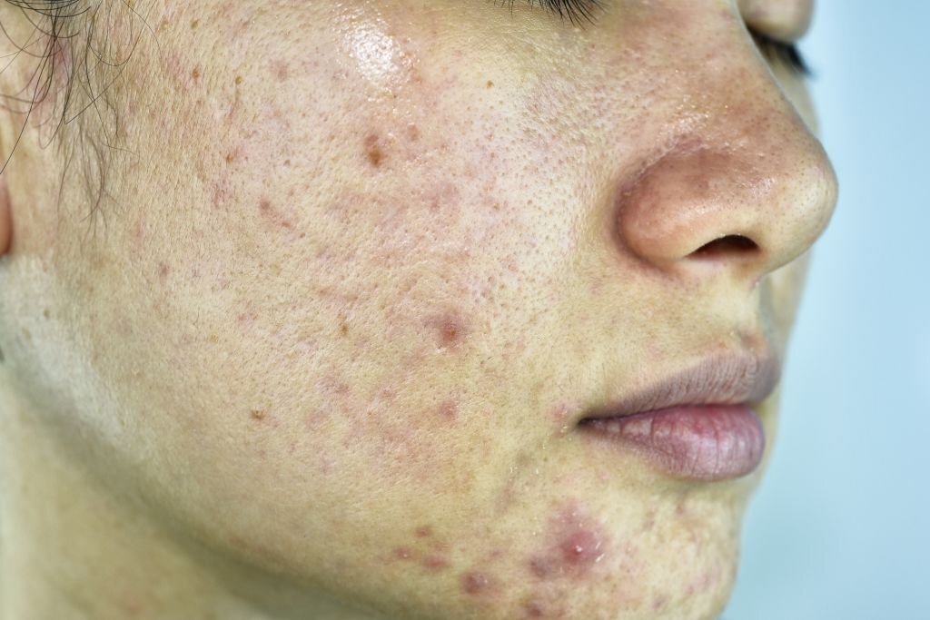 Read more about the article Cystic Acne and Junk Food