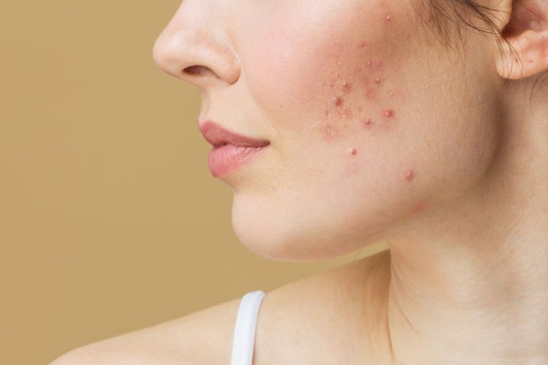 Read more about the article How to Get Control of Your Acne