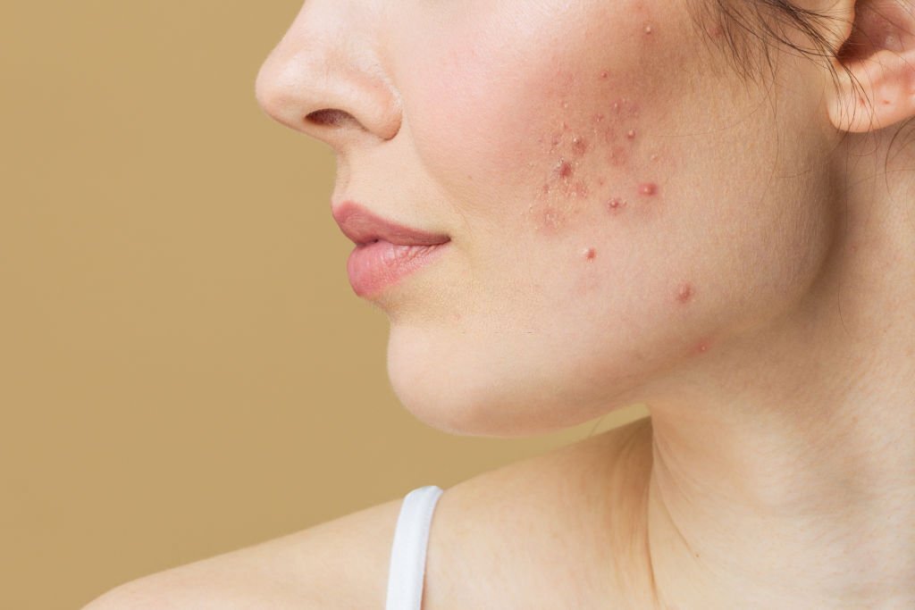 You are currently viewing How to Get Control of Your Acne