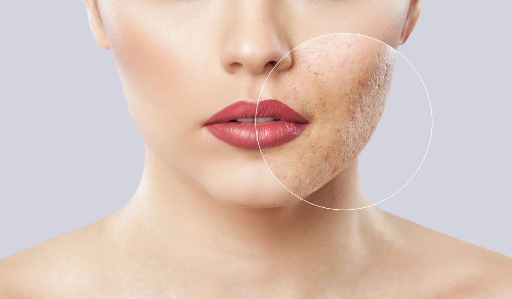 You are currently viewing How Can I Remove Acne Scars?