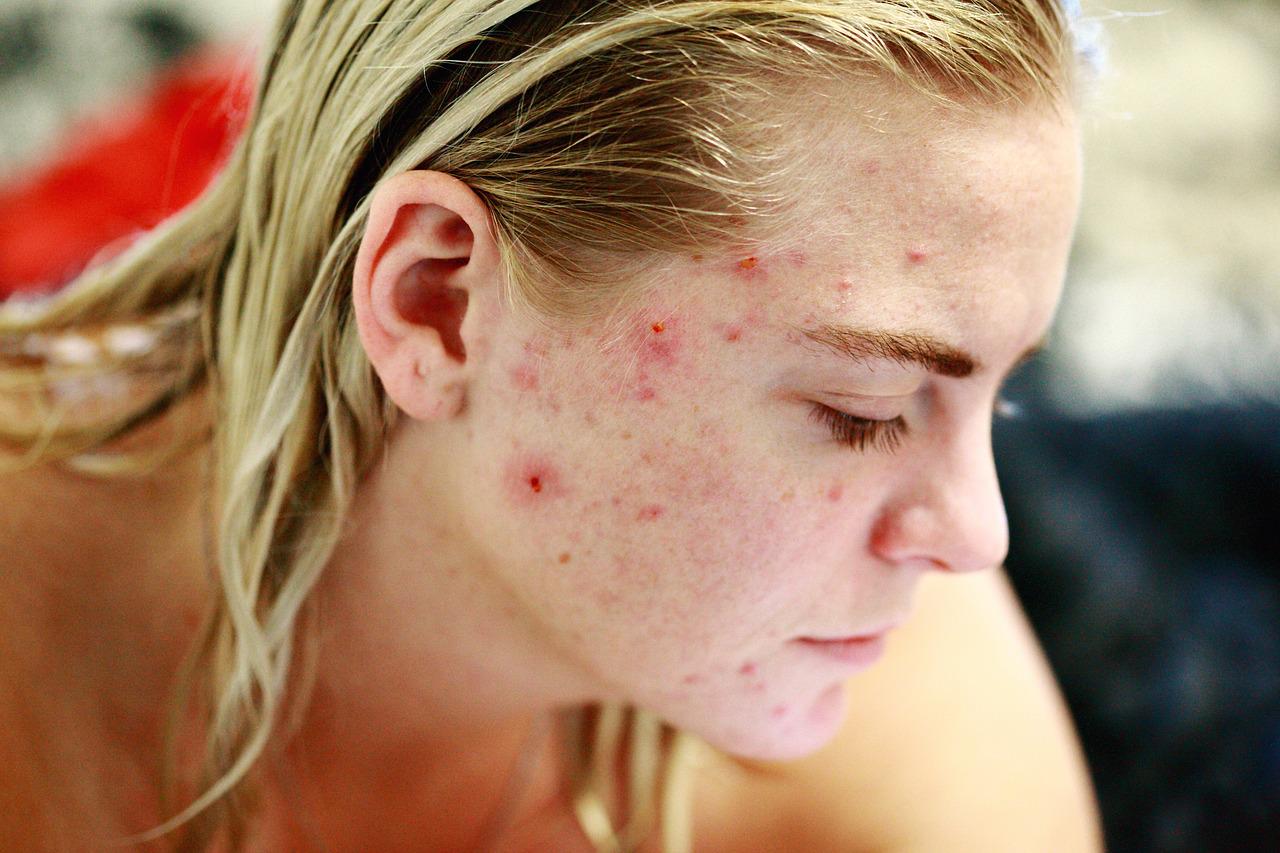 Read more about the article The List of 28 Most Common Frequently Asked Questions About Acne