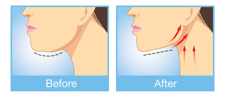 Read more about the article How to Get Rid of Neck Fat