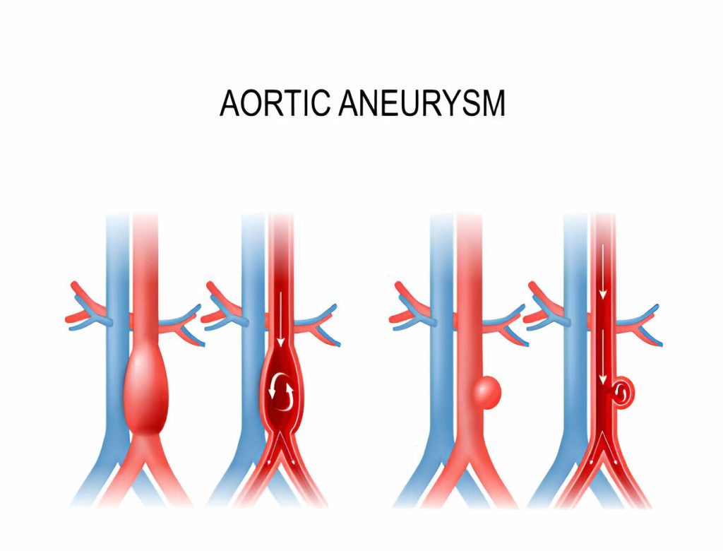 Aortic Aneurysm