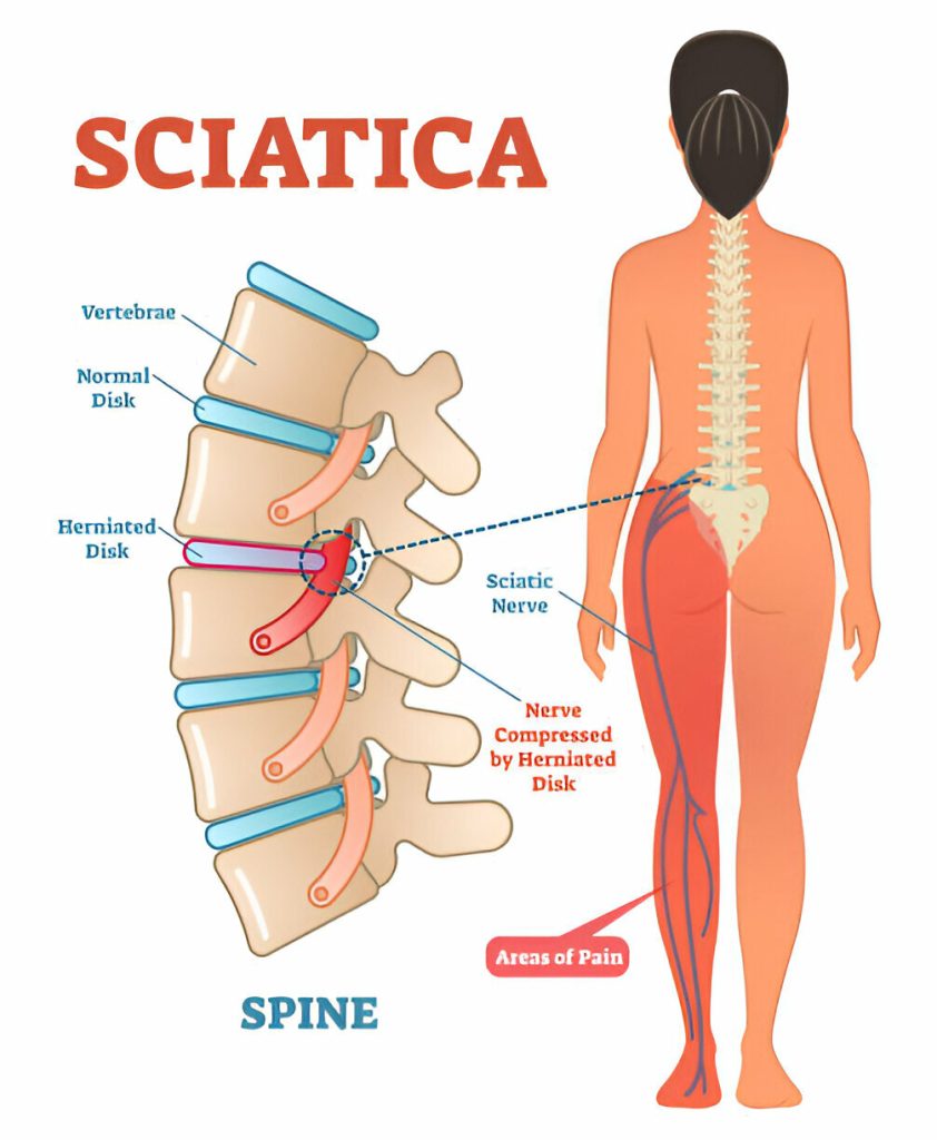 How To Get Rid Of Lower Left Back Pain 