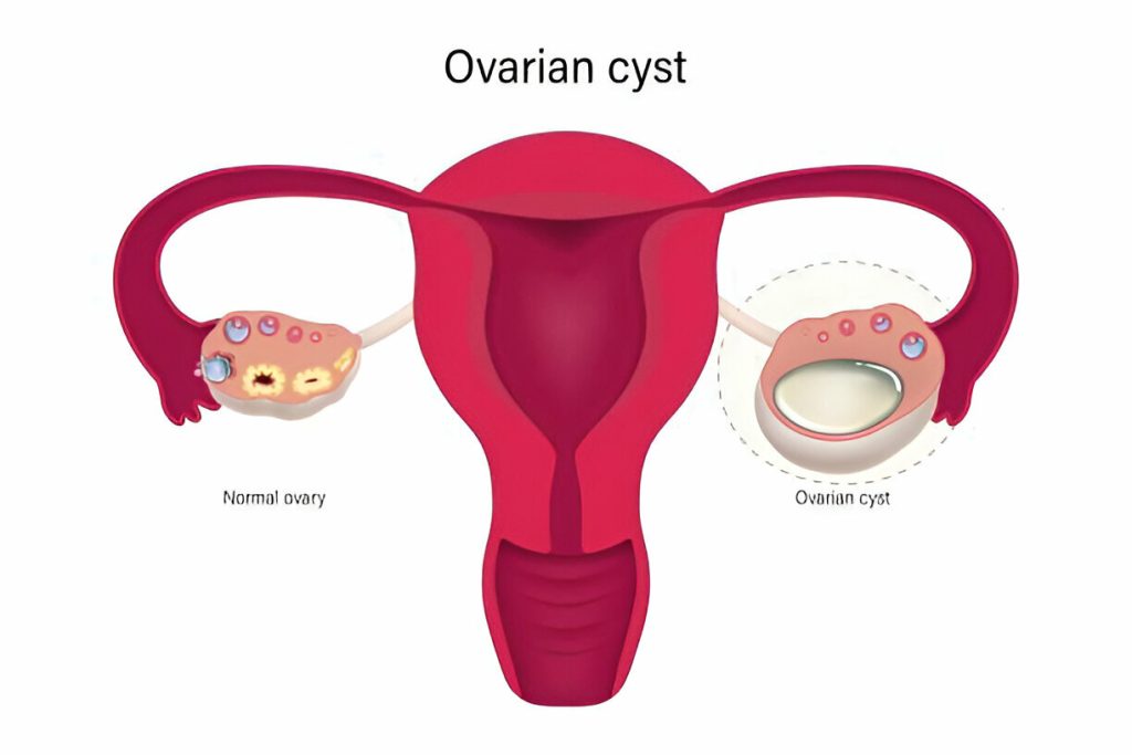 Ovarian cyst