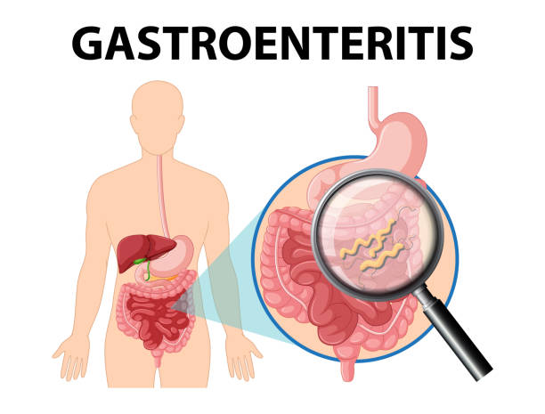 Gastroenteritis