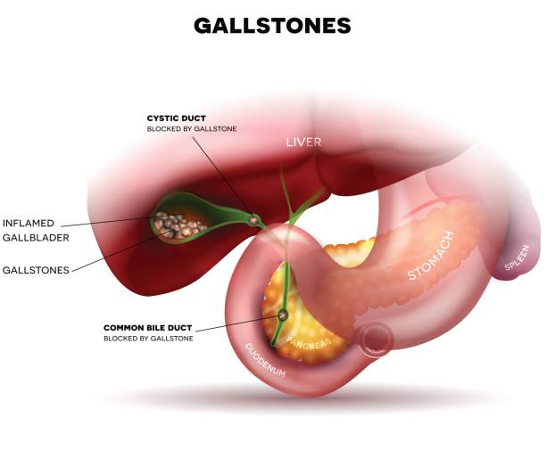 Gallastones