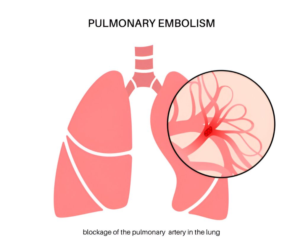 Pulmonary Embolism